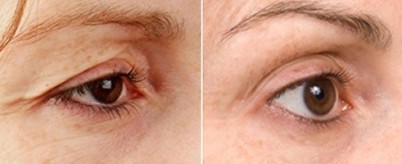 Мезотерапия кожи вокруг глаз| MEDSTYLE Алматы