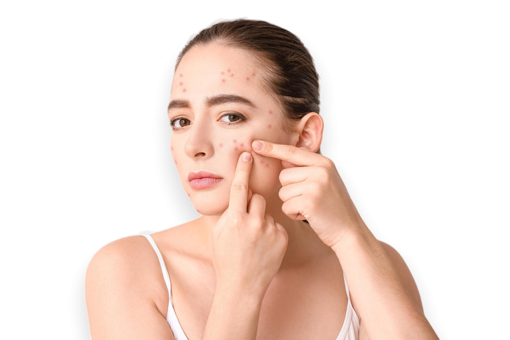 Лечение угревой сыпи  | MEDSTYLE Алматы