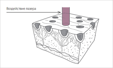 Фракционный лазер воздействие лазера | MEDSTYLE Алматы