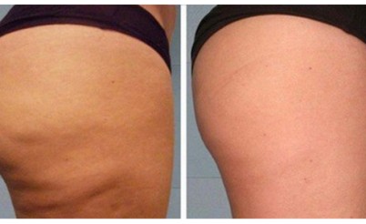 Мезотерапия тела | MEDSTYLE Алматы