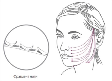 Нити Aptos Excellence Visage как выглядят | MEDSTYLE Алматы