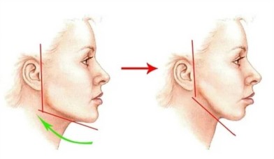 Коррекция углов челюсти угол молодости | MEDSTYLE Алматы