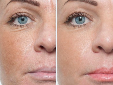 Биоревитализация до после | MEDSTYLE Алматы