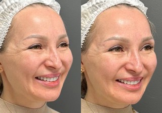 Коррекция височной области до после | MEDSTYLE Алматы