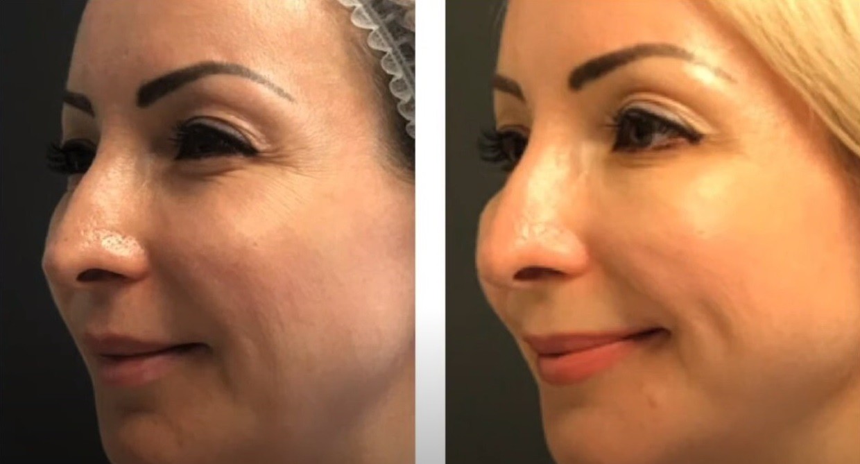 Гиалдиспорт видео процедуры | MEDSTYLE Алматы