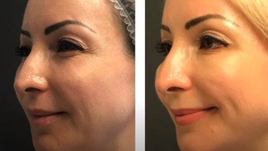 Гиалдиспорт видео процедуры | MEDSTYLE Алматы