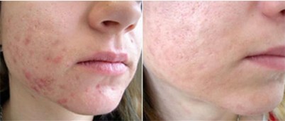 Мезотерапия при угревой сыпи | MEDSTYLE Алматы