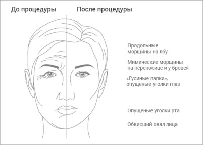 Dysport картинка до после | MEDSTYLE Алматы