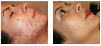 Лечение угревой сыпи до после | MEDSTYLE Алматы