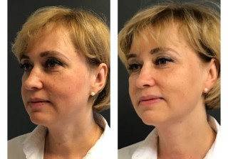 Жидкие нити до после 2| MEDSTYLE Алматы