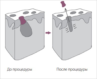 Чистка лица, декольте и спины процедура | MEDSTYLE Алматы