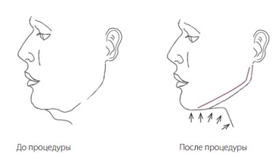 Липолитики по лицу до после | MEDSTYLE Алматы