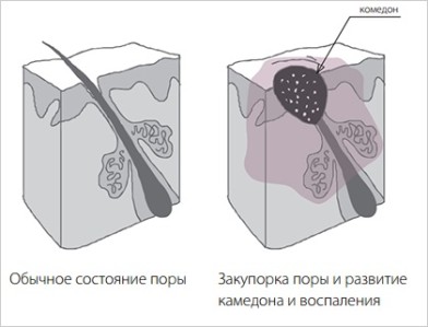 Лечение угревой сыпи комедон | MEDSTYLE Алматы
