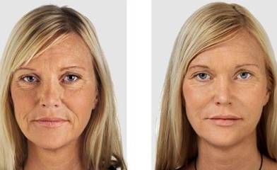 Коррекция морщин улыбки возле глаз и на щеках до после | MEDSTYLE Алматы