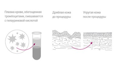 Гиаплазма 1| MEDSTYLE Алматы