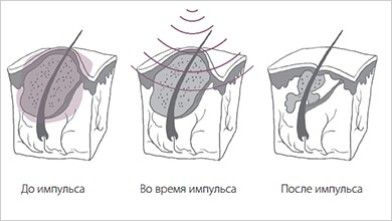 Лазерное лечение акне импульс лазера| MEDSTYLE Алматы