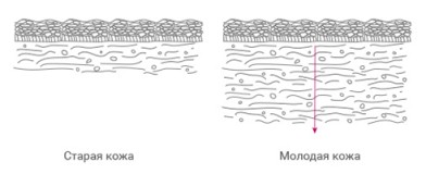 Мезотерапия старая и молодая кожа | MEDSTYLE Алматы