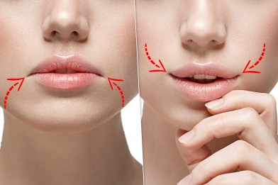 Поднятие углов рта до после | MEDSTYLE Алматы