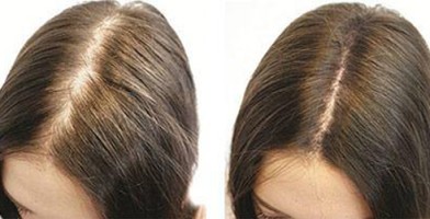 Плазмолифтинг волосяной части головы | MEDSTYLE Алматы