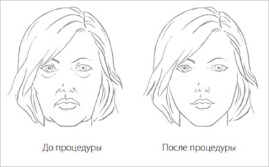 RF лифтинг FORMA до после| MEDSTYLE Алматы